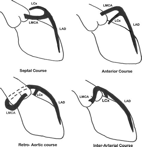 Coronary Artery Anomalies A Practical Approach To Diagnosis And