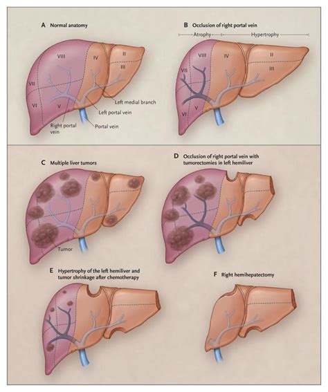 Liver Transplant Diagram