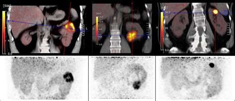 Snmmi Pet Tracer Describes Clear Cell Renal Cancer