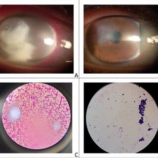 A Case Of Mixed Bacterial And Fungal Keratitis Pre A And Post