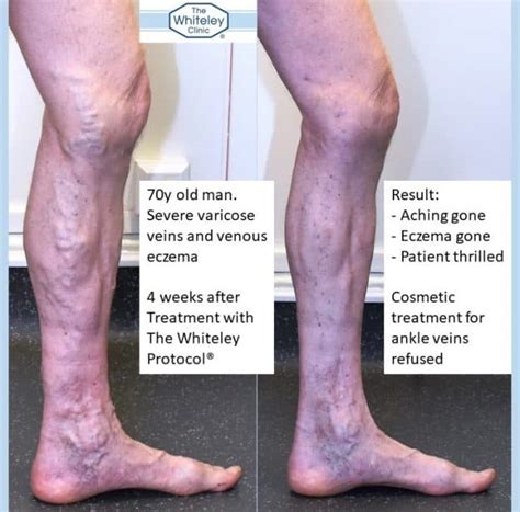 Varicose Eczema Cured By Whiteley Protocol