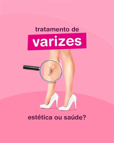 Tratamento De Varizes Est Tica Ou Sa De Rotina Da Saude