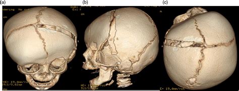 Multi Suture Craniosynostosis In Sotos Syndrome A Case Report Sultan