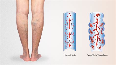 The Role Of Suction Thrombectomy For Deep Vein Thrombosis