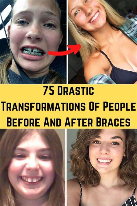 75 Drastic Transformations Of People Before And After Braces Braces