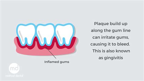 The Difference Between Plaque And Calculus Method Dental