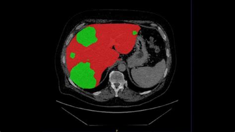 Liver Tumor Project Graylight Imaging