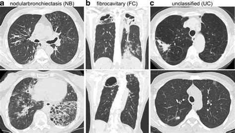 Representative Chest Ct Scan Images In Patients With Mxe Pd Enrolled In Download Scientific