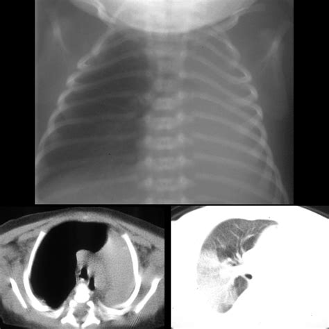 Newborn With Respiratory Distress Pediatric Radiology Case Pediatric Imaging Pedsimaging