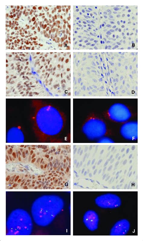 Immunohistochemical Staining Of MLH1 MSH2 And Aurora A And