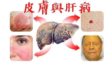 皮膚15症狀是肝有問題保健肝臟5方法柏格醫生 Dr Berg Youtube