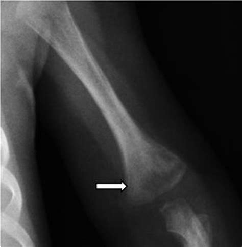 Congenital Syphilis Remember To Not Forget Bmj Case Reports