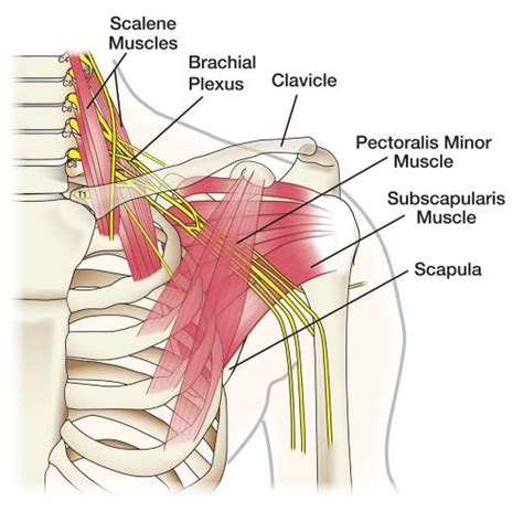 Brachial Plexus Injury Demystified