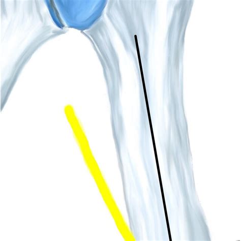 Location technique of the radial nerve with reference to the deltoid ...