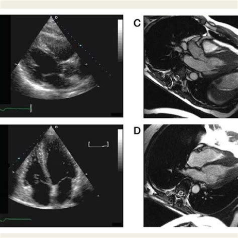 Catenoid Or Reverse Sigmoid Morphology By Echocardiography In A Download Scientific Diagram