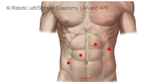 Trocar Placement Robotic Leftsigmoid Colectomy Youtube