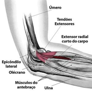 Epicondilite Lateral Do Cotovelo Dr Ricardo Kaempf Cirurgia De M O