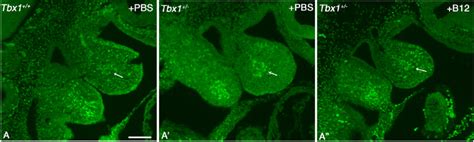 Tbx1 Gene Haploinsufficiency Causes SNAI2 Cell Condensation In The