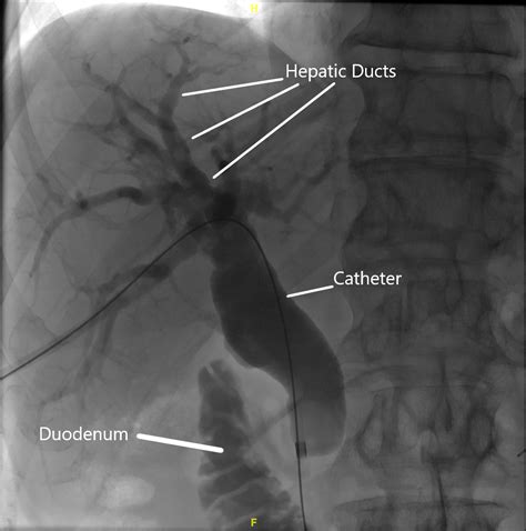 Ptc Hepatobiliary Upper Gastrointestinal Surgery