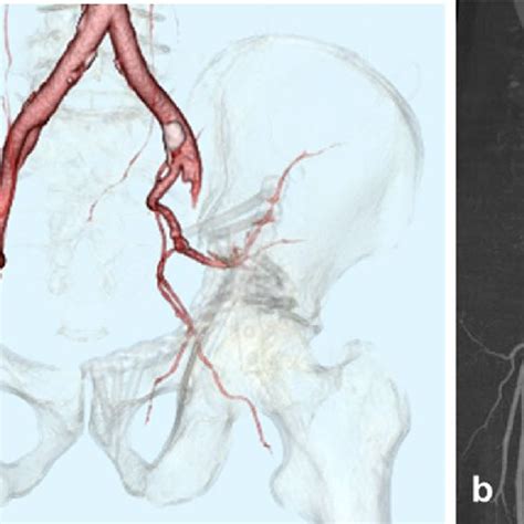 A Three Dimensional Computed Tomography Ct Angiogram Reconstruction