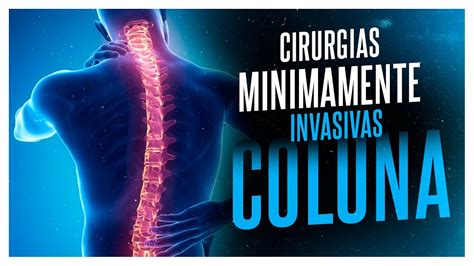 Entenda Como A Cirurgia Minimamente Invasiva Na Coluna Youtube