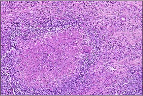 Typical Morphological Features Of Tubercular Granuloma On Electron Download Scientific Diagram