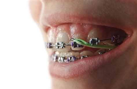 How Do Orthodontic Elastics Work When Wearing Braces Wonder West Orthodontics