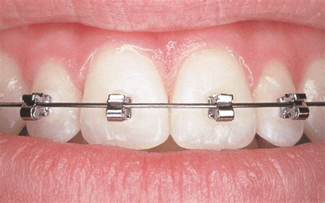 Waterpik or Oral Irrigator? - How to Floss with Braces?