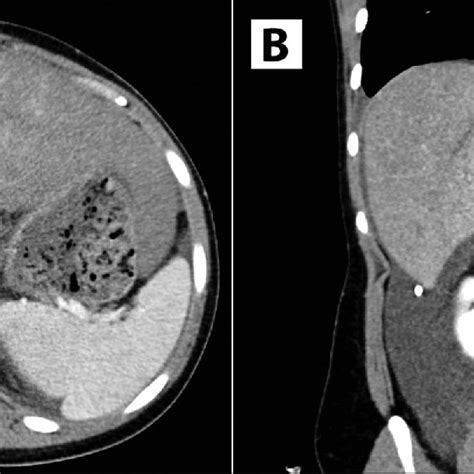 Axial A And Coronal B Views Of Computed Tomography Angiograms