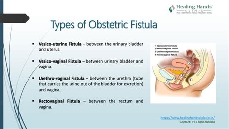 Obstetric Fistula: Causes, Symptoms and Treatment | PPT