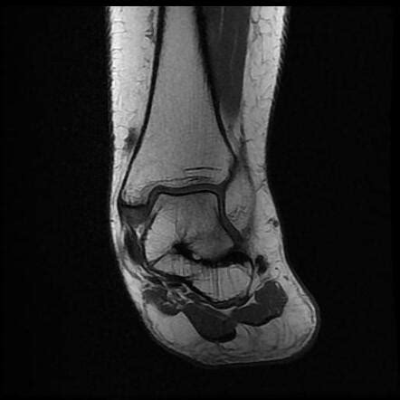 Talocalcaneal coalition | Radiology Case | Radiopaedia.org