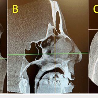 Computerized tomography scan of the nose and sinuses CT imaging reveals ...