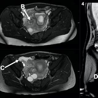 MRI Of The Abdomen Demonstrating Haemoperitoneum And A Complex Ruptured