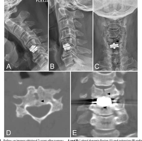 [pdf] Vertebral Body Split Fracture After A Single Level Cervical Total