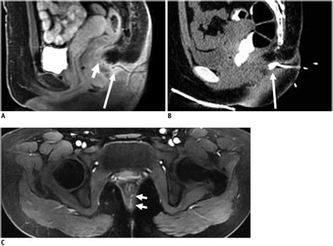 Imaging Of Anal Fistulas Comparison Of Computed Tomographic