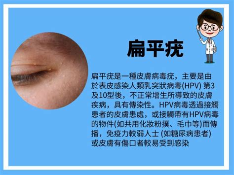 粟粒疹原因 確研皮膚專科中心 Precise Dermatology And Laser Centre