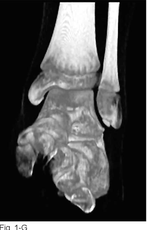 Figure 2 from Operative Indications and Treatment for Chronic ...