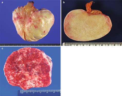 Ovarian Sex Cord Stromal Tumors Basicmedical Key