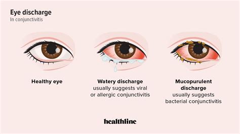 Mucopurulent Conjunctivitis Causes Symptoms And Treatment