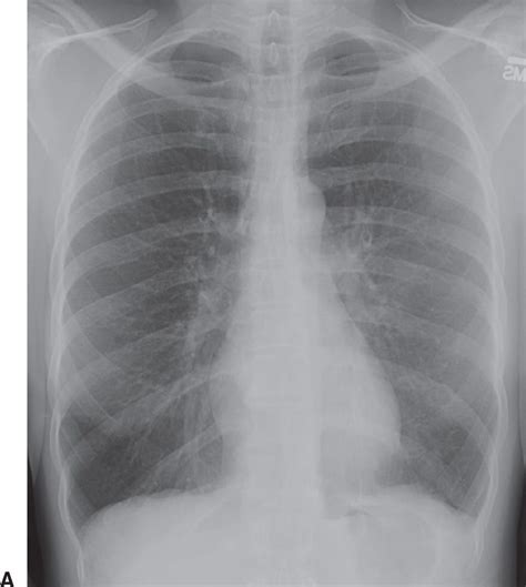 Mediastinal Masses Radiology Key