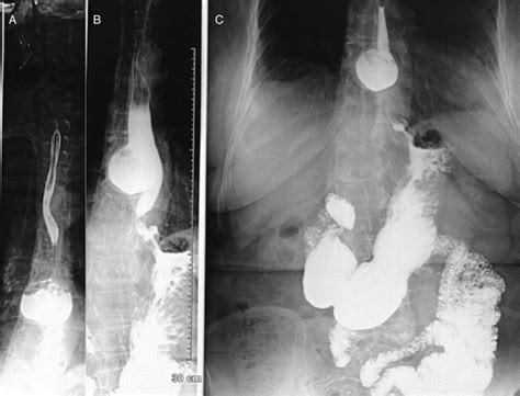 Barium Swallow Showing An Epiphrenic Diverticulum A And B Oblique