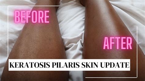 How To Cover Up Keratosis Pilaris What Im Currently Using Kp Dark