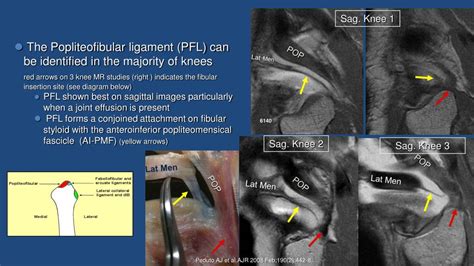 Ppt Posterolateral Corner Of The Knee Mri Anatomy Functional