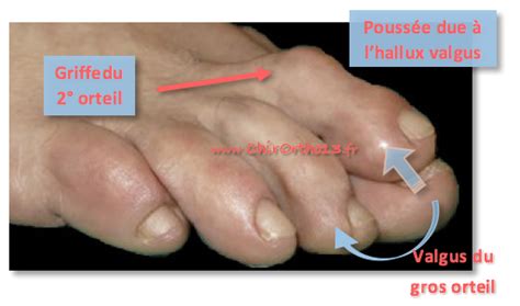 Hallux Valgus Et Autres Pathologies De Lavant Pied Chirortho13fr