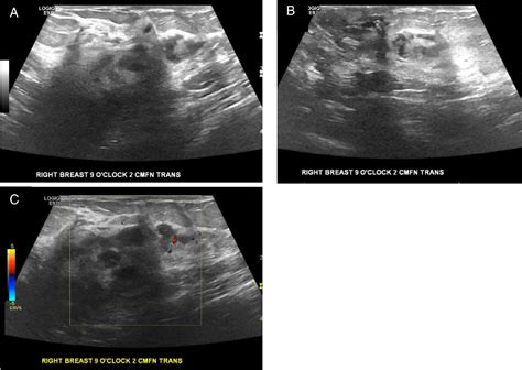 Figure 3 From Breast Manifestation Of Extramedullary Myeloid Sarcoma A