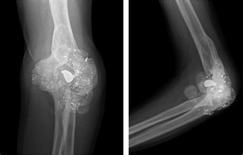 -Left elbow X-ray (4 years after initial X-ray): Presurgical X-ray... | Download Scientific Diagram