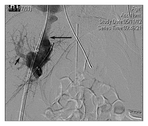 Percutaneous Venogram Demonstrating Opacification Of The Right Portal