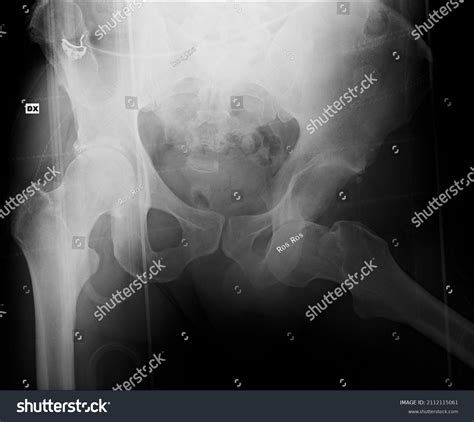 309 Hip Dislocation Surgery Images, Stock Photos & Vectors | Shutterstock