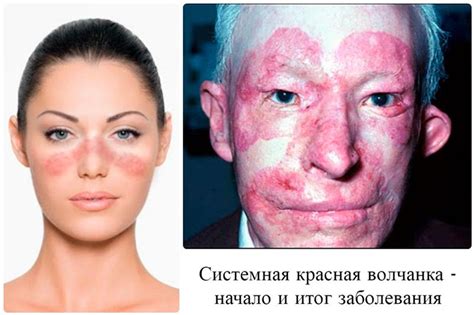 Волчанка симптомы и лечение и фото