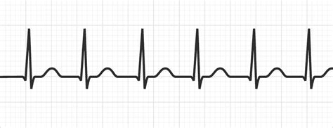 Av Nodal Reentrant Tachycardia